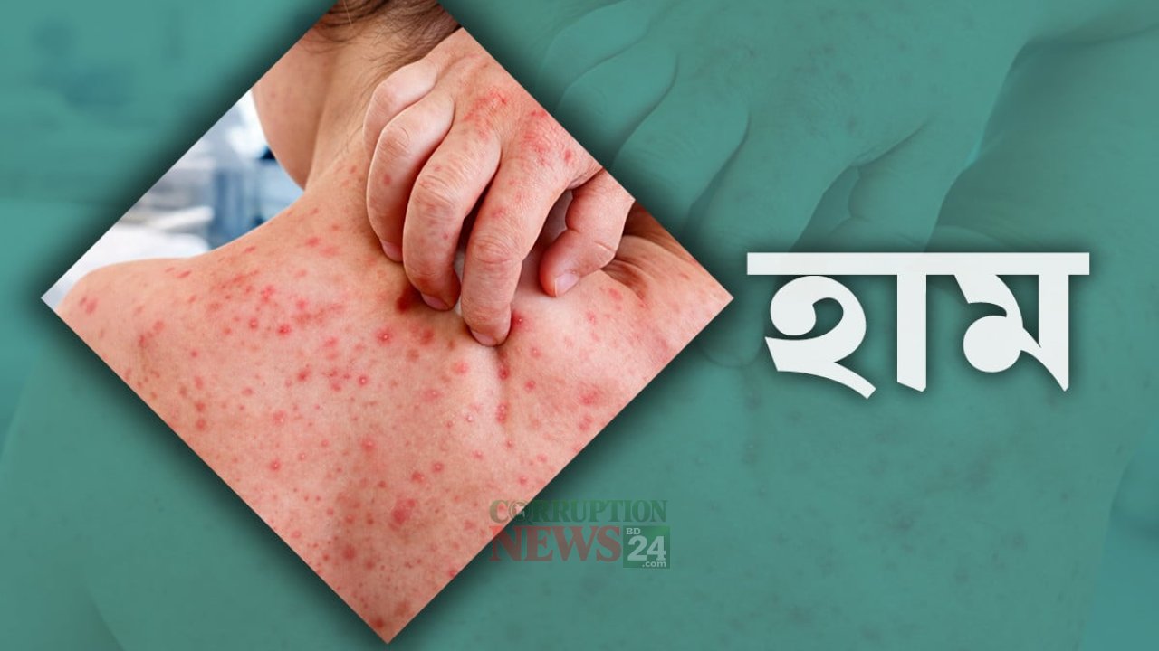 হ্যামের উপসর্গে আরেকজনের মৃত্যু, দেশের আক্রান্ত সংখ্যা পৌঁছেছে ১,৮৪০